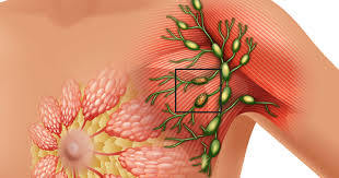 Meme Kanseri: Onkoplastik Cerrahi ile Estetik ve Sağlık Bir Arada
