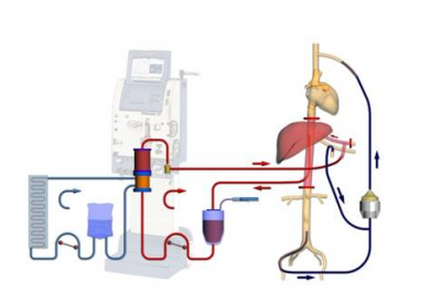 İzole Ekstremite Perfüzyonu: Uzuv Koruyucu Tedavi