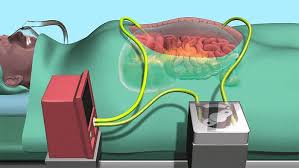 Karın İçi Sıcak Kemoterapi (HIPEC): Gelişmiş Bir Tedavi Seçeneği