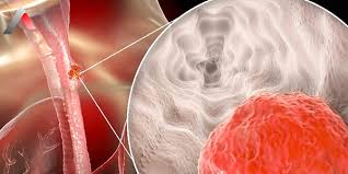 Özofagus Kanseri: Zor Ama Başarılabilir